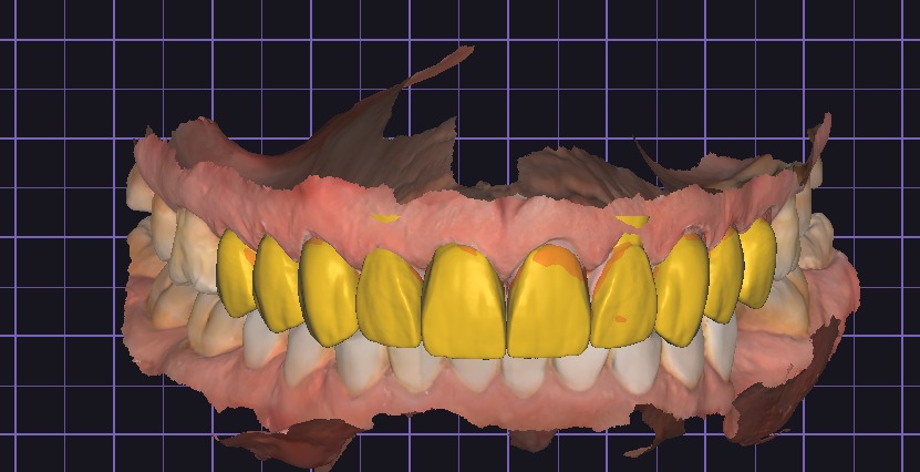 Je vais te concevoir une couronne exocad - portfolio - 0