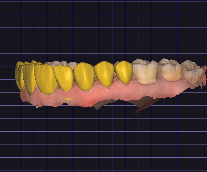 Je vais te concevoir une couronne exocad - portfolio - 1