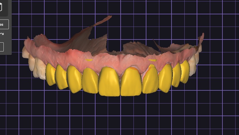 Je vais te concevoir une couronne exocad - portfolio - 2
